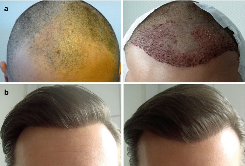 The Technique Of Minimally Invasive Hair Transplantation Springerlink