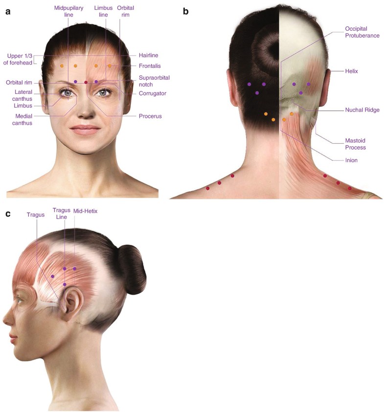 Chronic Migraine Epidemiology, Mechanisms, and Treatment SpringerLink