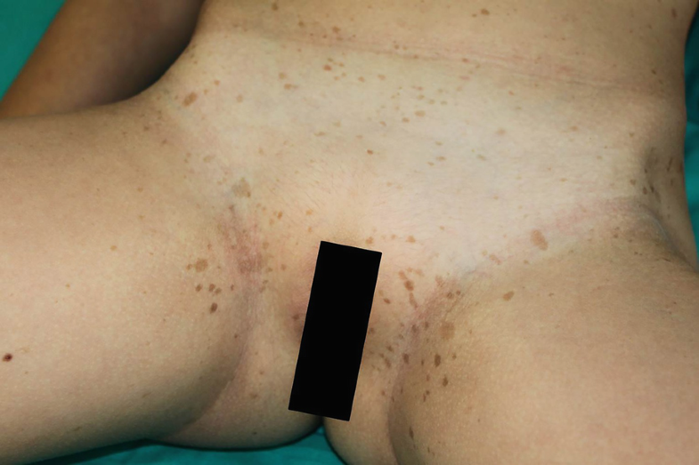 Clinical Features Of Nf1 In The Skin Springerlink