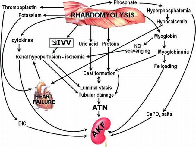Myoglobinuric Acute Kidney Failure Springerlink