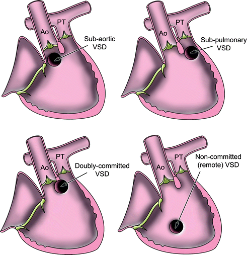 Double Outlet Right Ventricle | SpringerLink