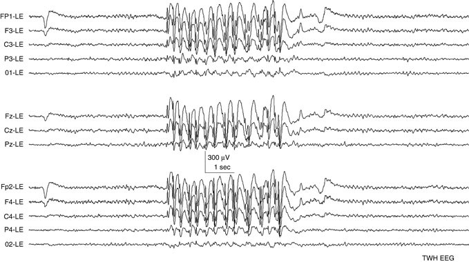 epilepsy eeg vs normal eeg epilepsy eeg vs normal eeg