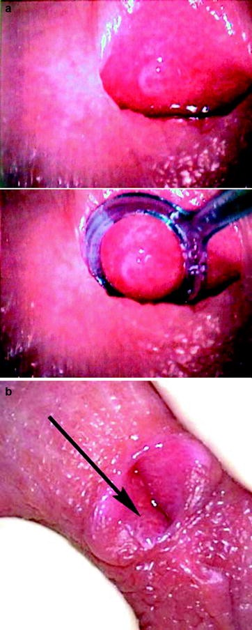 hpv lesion meatus)