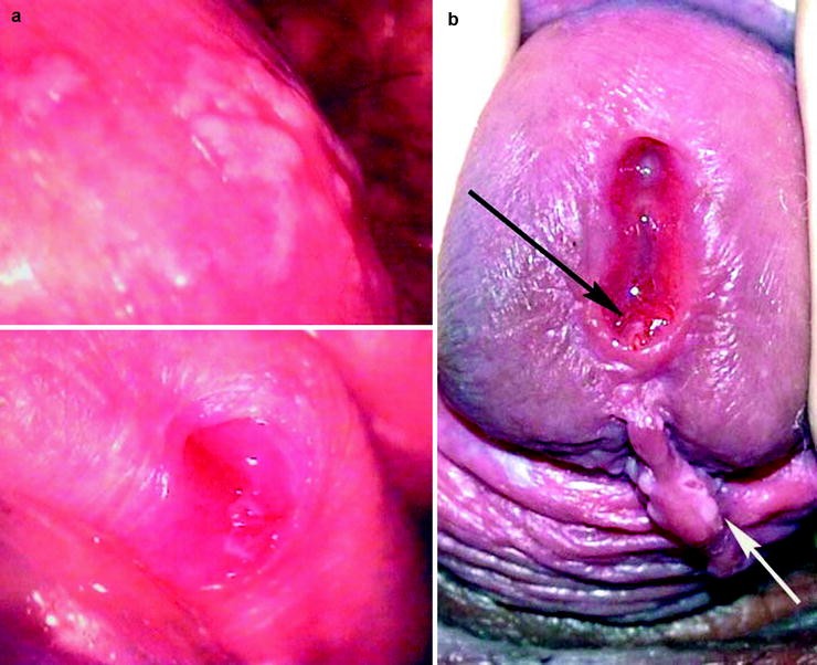 Papillary lesion urethra Hpv warts in urethra