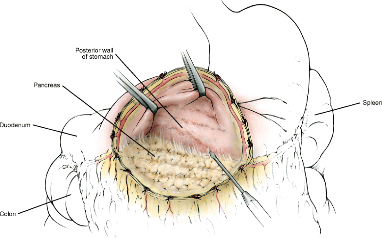 Pancreas and Duodenum | SpringerLink