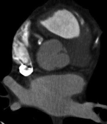 Cardiac Multislice Ct Springerlink
