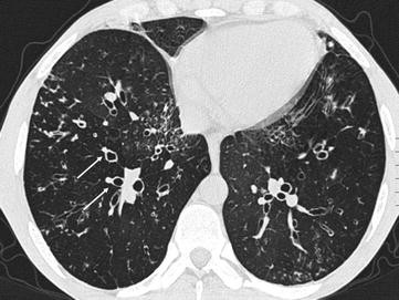 Trachealis papillomatosis ct - Paraziták kezelése körömvirággal