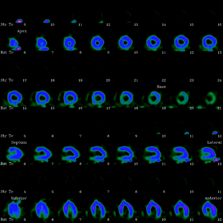 Fundamentals Of Image Processing In Nuclear Medicine Springerlink