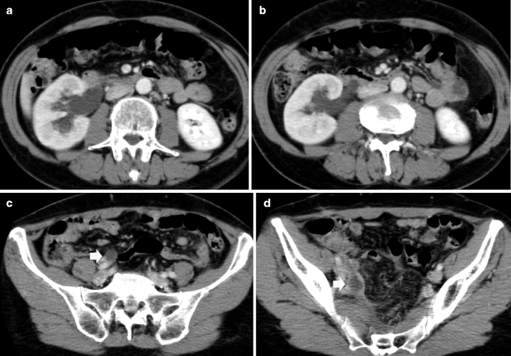 Obstructive Uropathy, Pyonephrosis, And Reflux Nephropathy In Adults ...