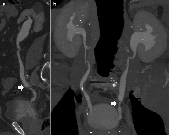 Obstructive Uropathy, Pyonephrosis, And Reflux Nephropathy In Adults ...