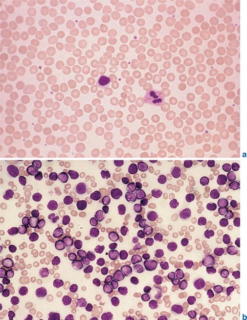 Leukemia Springerlink Images, Photos, Reviews