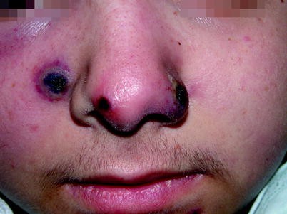 Nasal Vestibulitis And Nasal Furunculosis And Mucormycosis