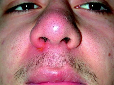 Nasal Vestibulitis And Nasal Furunculosis And Mucormycosis
