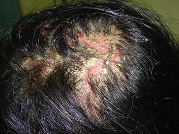Hair Disorders And Alopecia Springerlink