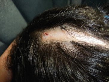 Hair Disorders And Alopecia Springerlink