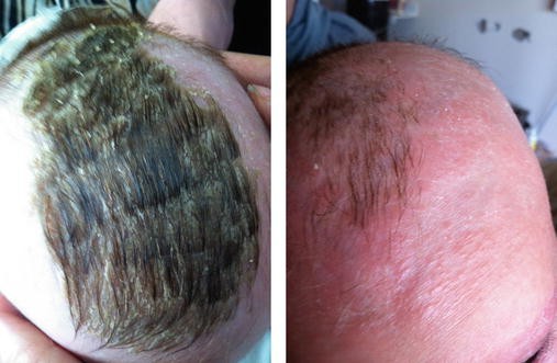 Hair Disorders And Alopecia Springerlink