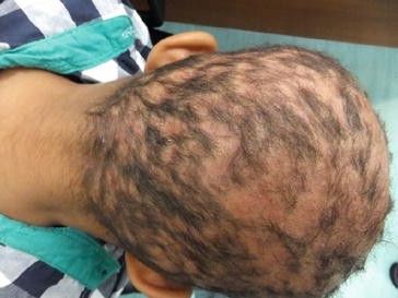 Hair Disorders And Alopecia Springerlink