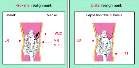 Lateral Release of the Lateral Patellar Retinaculum: Literature Review