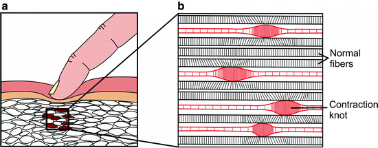 Morphology Of Myofascial Trigger Points What Does A Trigger Point Look Like Springerlink
