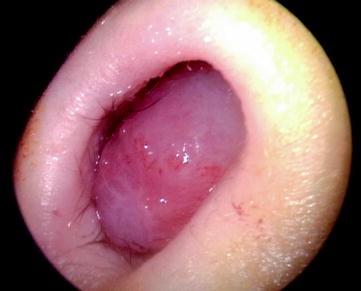 nasal polyps in toddlers