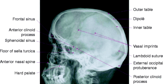 sinus papilloma c3