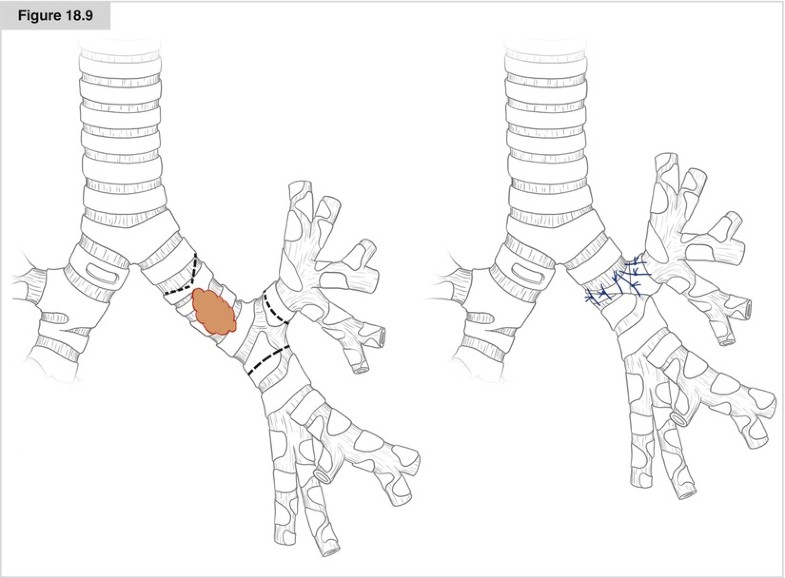 Bronchial Sleeve Resection SpringerLink