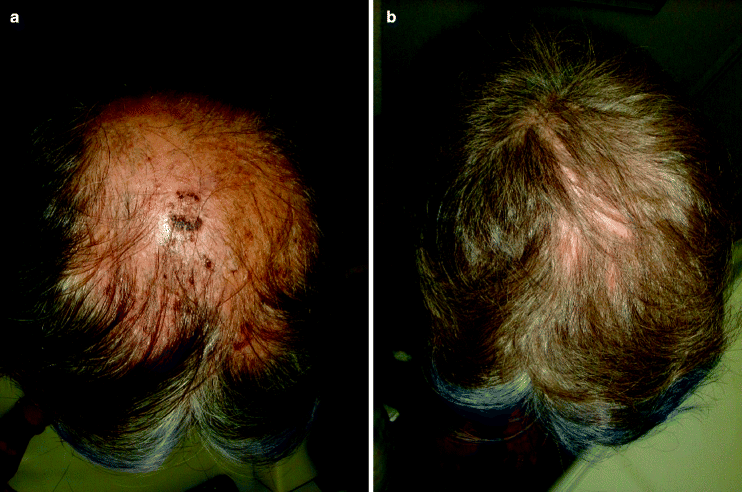 Micronutrients For Hair And Nails Springerlink