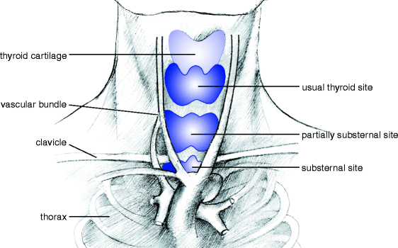 Substernal Goiter | SpringerLink