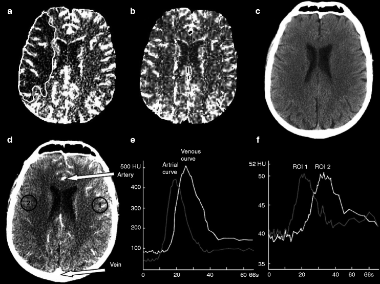 Ct Perfusion Ctp Springerlink