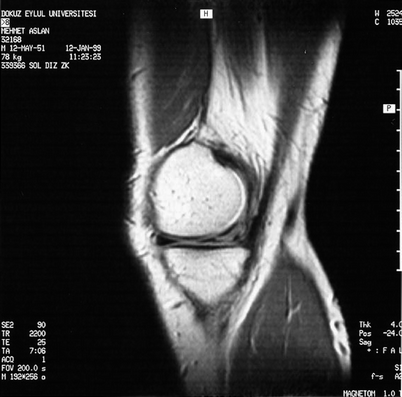 Mucoid Degeneration and Cysts of the Meniscus | SpringerLink