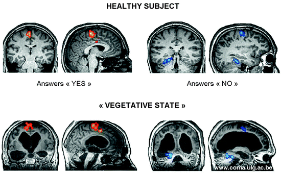 Disorders Of Consciousness Coma Vegetative And Minimally Conscious States Springerlink