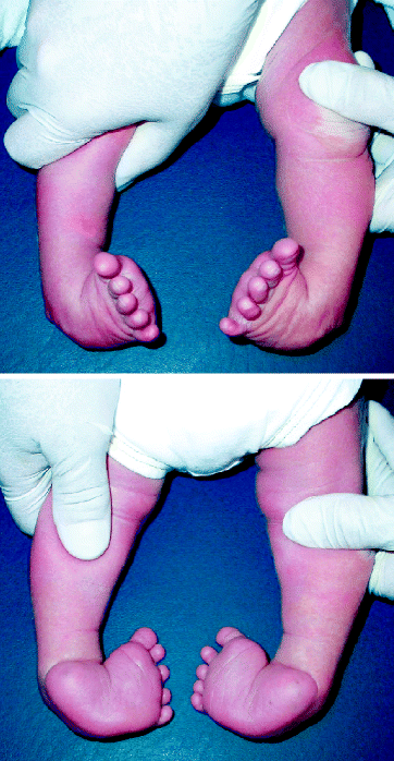 The Current State Of Treatment For Clubfoot In Europe Springerlink