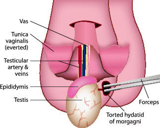 F Acute Scrotal Exploration SpringerLink