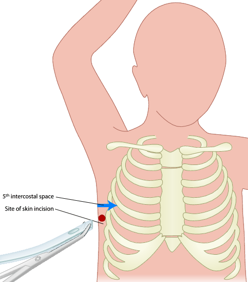 D1 Chest Tube Insertion Springerlink
