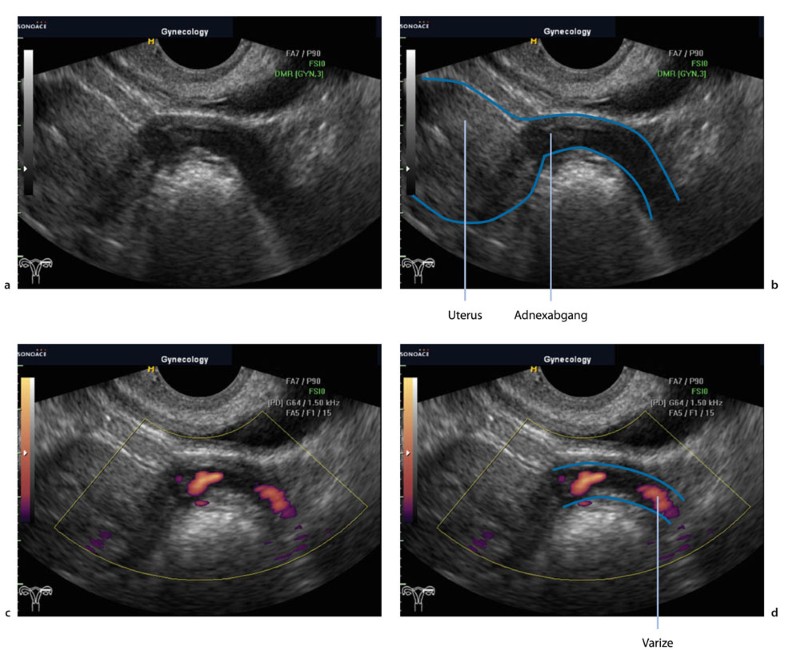 Hoch Aufgebaute Schleimhaut Und Ziehen Im Unterleib Gynäkologischer Ultraschall | SpringerLink