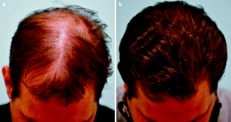 Hair Restoration Springerlink
