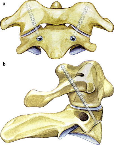 Anterior Transarticular Screw Fixation C1/C2 | SpringerLink