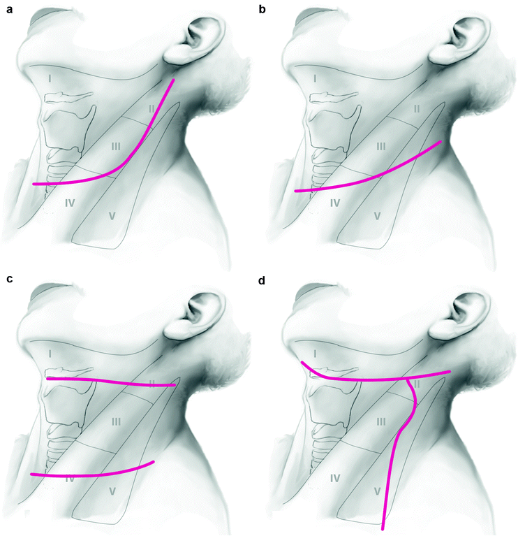 Modified Radical Neck Dissection SpringerLink