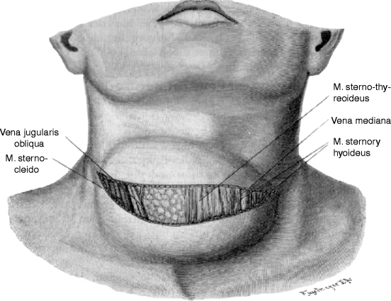 History of Thyroid Surgery: The Kocher Incision | SpringerLink