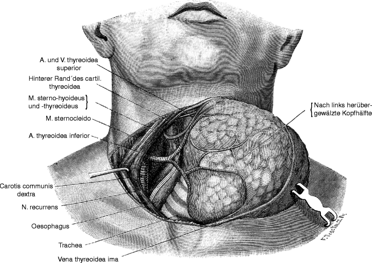 History of Thyroid Surgery The Kocher Incision SpringerLink
