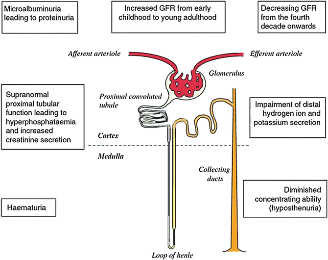 Sickle Cell Nephropathy in Children | SpringerLink