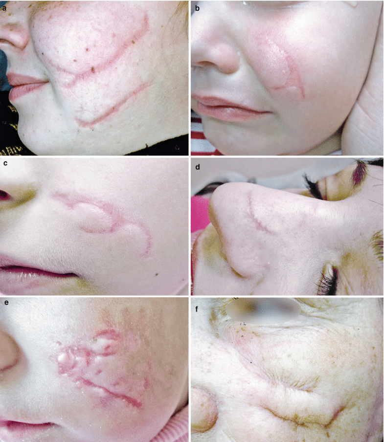 cat scratch scar removal