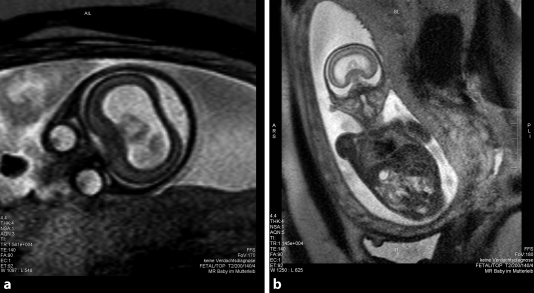 Fetale Magnetresonanztomografie Springerlink