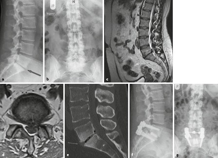 Bandscheibenvorfall Springerlink