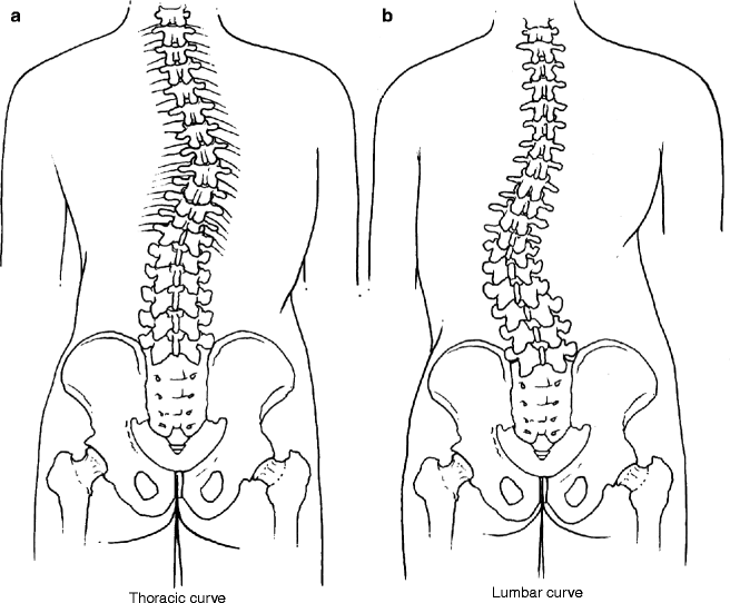 Scoliosis SpringerLink