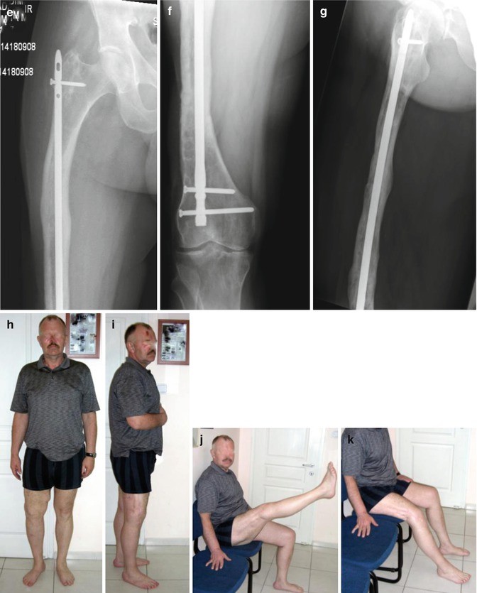 Management of Delayed Union, Non-Union and Mal-Union of Long Bone ...