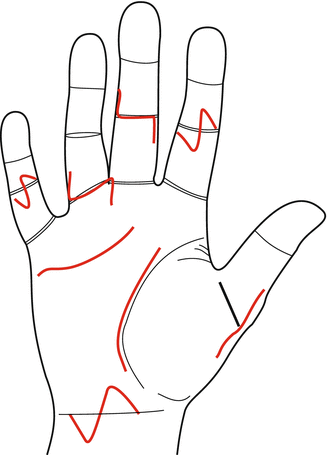 brunner type incision