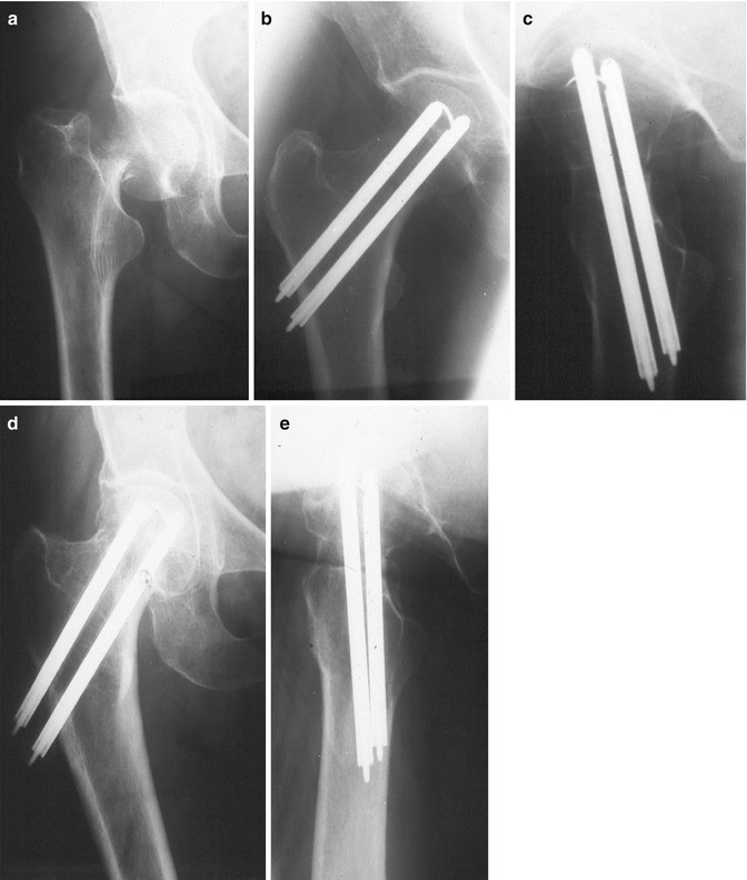 orif femoral neck fracture