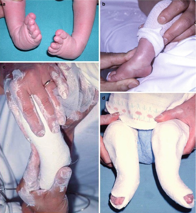 Management Of Clubfoot Springerlink Management Of Clubfoot Springerlink