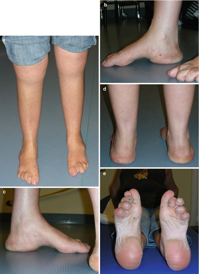Surgical Treatment of Cavus Foot Deformity | SpringerLink